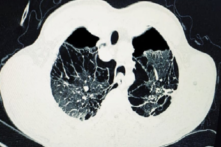 Chest computed tomography showed a bilateral partial pneumothorax (green arrows) predominant on the left side undergoing