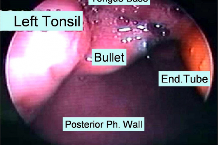 Figure 3: Endoscopic view showing the bullet lying transversely in the pharynx between tongue base, left tonsil and making contact with the posterior pharyngeal (ph.) wall. The endotracheal (End.) tube is seen in the right side of the view.