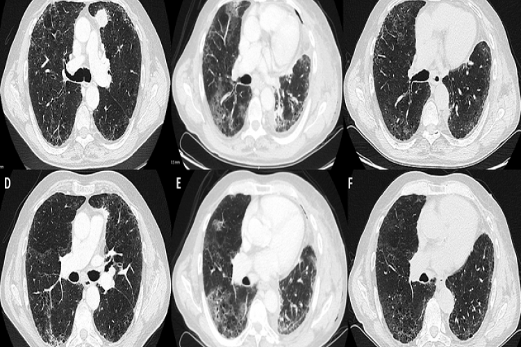 Computer tomography of the chest showing the preoperative aspect of the lung (A,D), the presence of an upper left adenocarcinoma (A), and the radiological aspect of the same sections at the hospital readmission (B,E) performed ten days after discharge which evidence of diffuse ground glass opacities. (C,F) represent computer tomography of the chest performed eleven days after readmission and antibiotic and steroid therapy and non-invasive ventilation showing the disappearance of ground glass opacities.