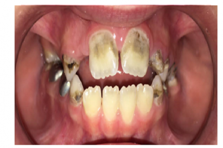 Anterior teeth of the 8-year-old boy showing a mild brown