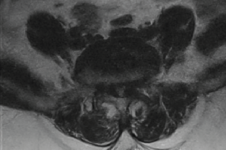 Magnetic resonance images of the Lumbosacral spine