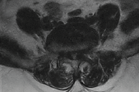 Magnetic resonance images of the Lumbosacral spine