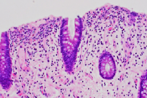Microscopic findings of the BUMP. This lesion is the proliferation of plump, uniform spindle cells with eosinophilic cytoplasm, indistinct cell borders,