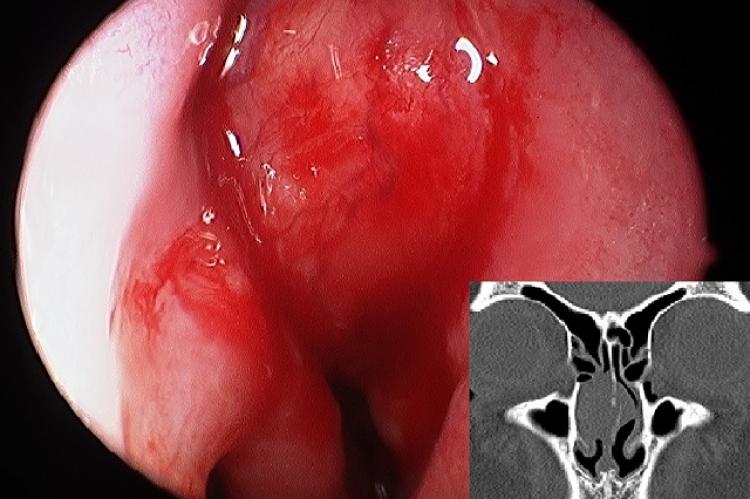 Endoscopic view of a vascular lesion of the right nasal septum