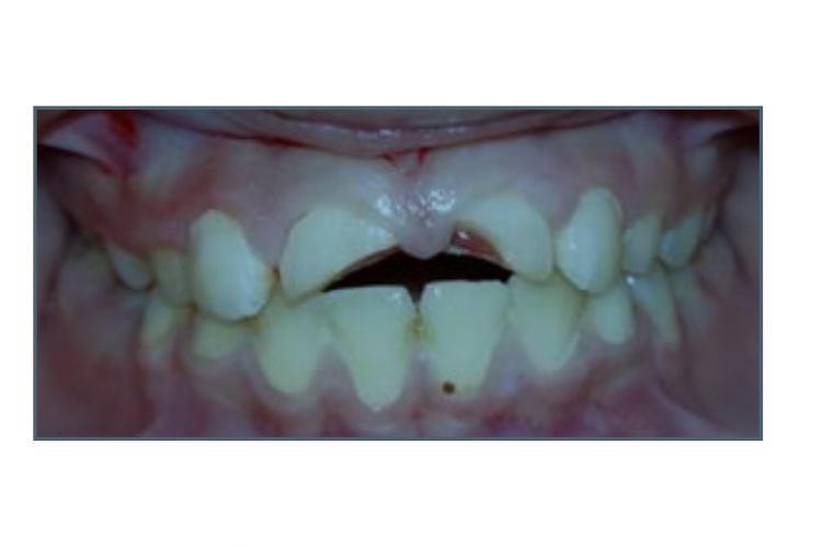 Management of Complex Crown Fracture using Fiber Post and Strip crowns: A Case Report