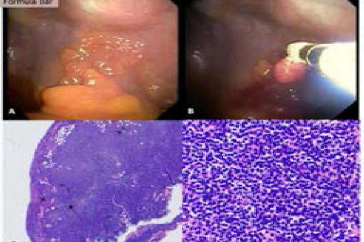 Pleuroscopic view and biopsies of the pleural lymphoma