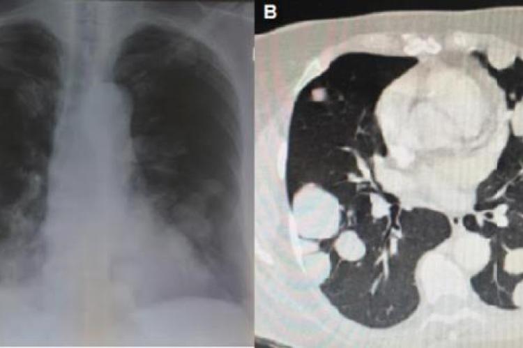 Radiographic characteristics of pulmonary metastases of atypical meningioma; (A) chest X-ray, (B) multislice computed tomography.