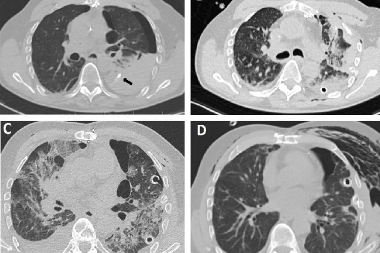 (A) CT scan showing chest drainage (black arrow) causing lung laceration with adjacent large hemothorax (Day 1), (B) Postoperative CT scan showing intraparenchymal bleeding into the left lung, (C) CT scan showing severe ARDS (Day 3), (D) CT scan after weaning from PMLV (Day 13).