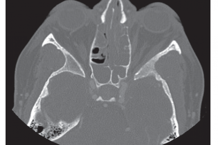 Figure 1: Imaging performed during initial presentation showed extensive pansinusitis, absence of septum, dehiscence of left lamina papyrecia, and mild left eye proptosis.