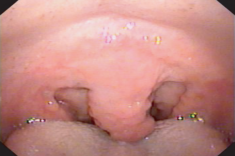 Figure 1: Oral cavity showing irregular thickening.