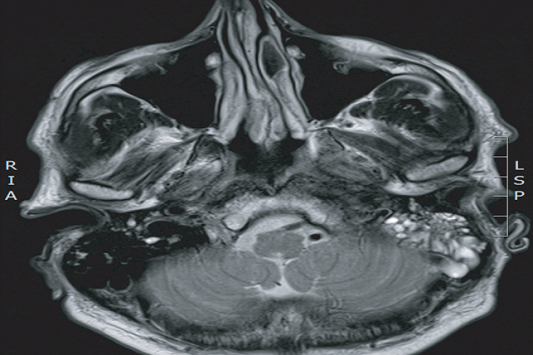 Figure 1: MRI head, revealing diffuse pachymeningeal enhancement and abnormal enhancement of the right facial nerve.