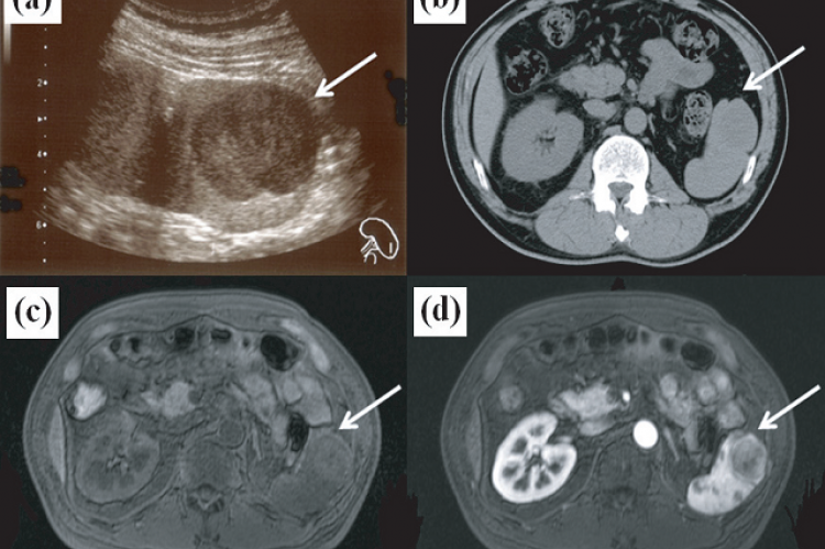 Figure 1: Imaging findings. (a) Abdominal ultrasonography showing a homogeneous, hypoechoic solid mass in the lower portion of the spleen. (b) Abdominal computed tomography scan showing a focal solid splenic mass (arrow). (c) Magnetic resonance imaging (MRI) showing a hyperintense mass on a T1-weighted image. (d) Postcontrast subtracted image on dynamic MRI. The lesion was enhanced with time.