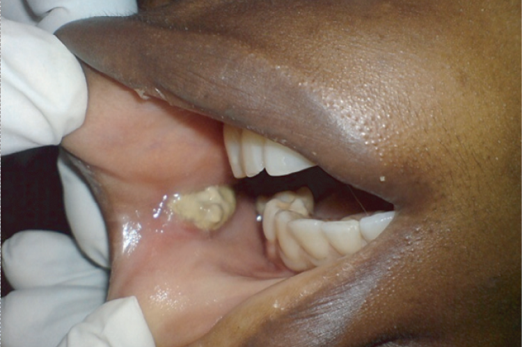 Figure 2: The necrotic ulcer on the right buccal mucosa.