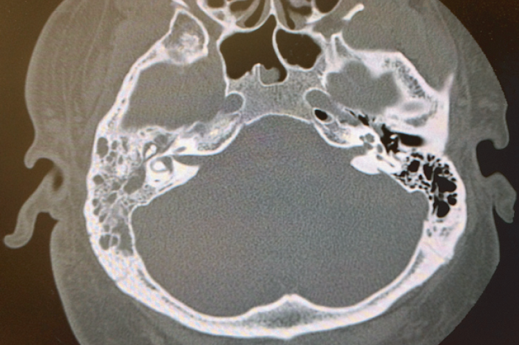 Figure 1: Axial head CT demonstrates right-sided otomastoiditis that extends into the right petrous apex without evidence of bony erosion. The left side shows well-aerated mastoid air cells.