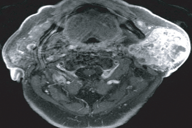 Figure 1: Axial T1 weighted image with gadolinium showing an enhancing mass of the left parotid gland with multiple area of cyst formation or necrosis with in the mass.