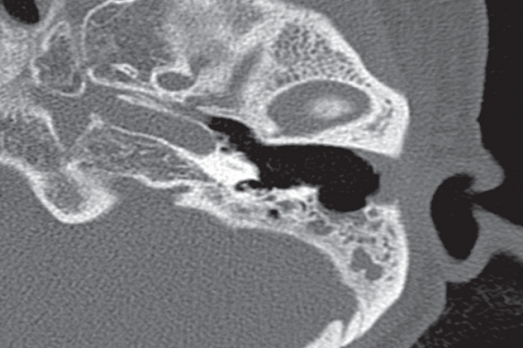 Figure 1: Axial CT scan of the left temporal bone showing a large fistula between the external auditory canal and the mastoid cavity. The middle ear is well aerated, and the mastoid is filled with a soft-tissue density.