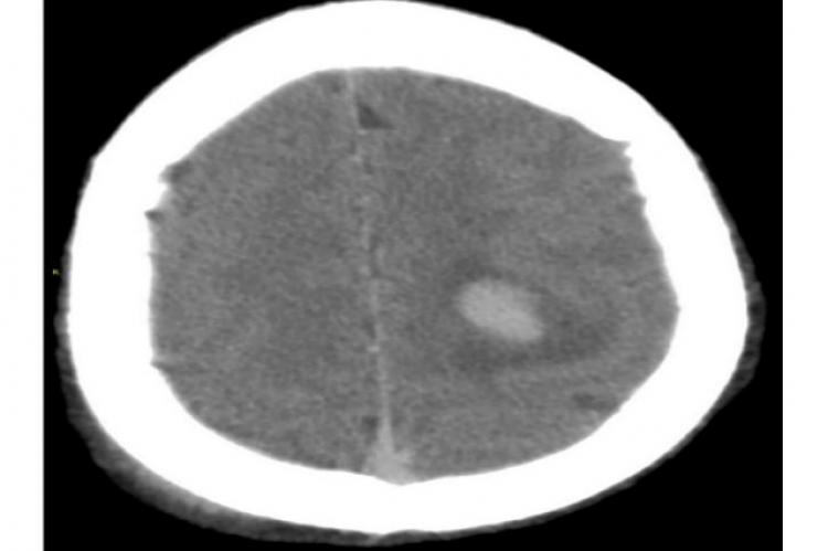 Figure 1. A ovoid high-density shadow in the left parietal lobe, about 2.3cm x 1.5cm in size,the CT numerical value is 63HU. The boundary is clear, there is a large area of edema around the lesion,and intracranial arteriovenous density increased significantly.