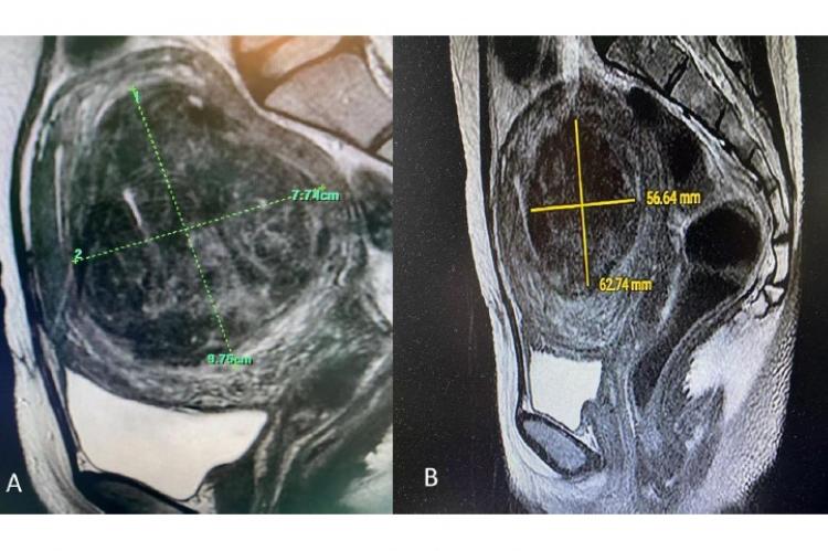 MRI image of a fibroid