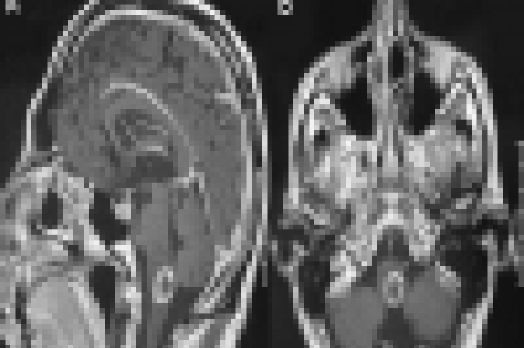 T1-weighted magnetic resonance imaging of the brain [(A) sagittal plan; (B), axial plan] showing a 1.8 cm peripherally enhancing metastatic lesion of the brainstem.