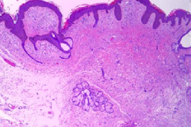 Neurofibroma- benign dermal proliferation of wavy Schwann like cells, col HE, ob. 4x.