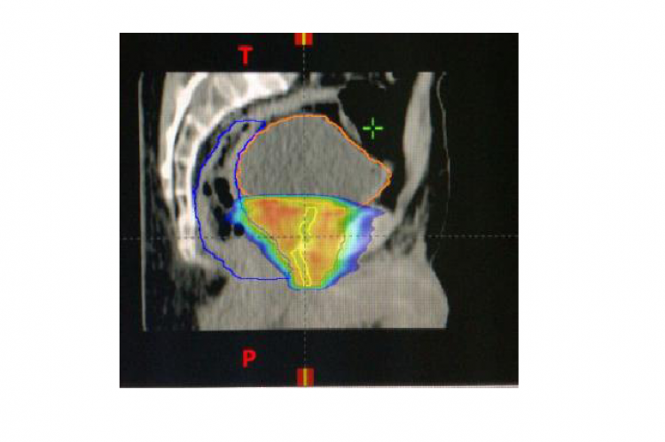 Isodoses distribution of prostate clinical target volume: CTV prostate.