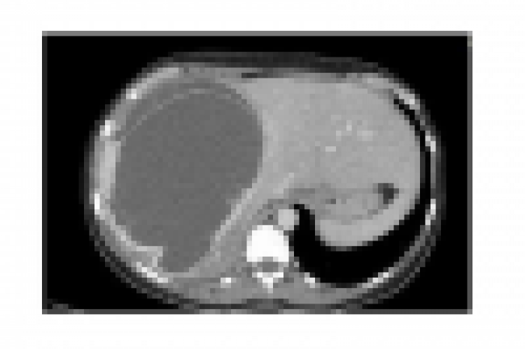 Computed tomography revealed a large cystic lesion in the right hepatic lobe (white arrow).