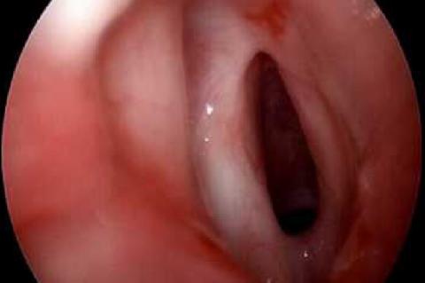 The figure shows the initial presentation of the patient’s airway. This view was obtained prior to microdirect laryngoscopy