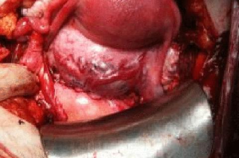 Uterus in situ post caesarean