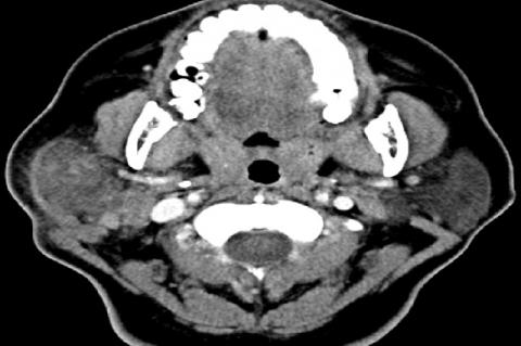 Computed tomography with contrast exhibited heterogeneous right parotid gland and peripheral enhancement