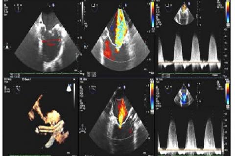 Transesophageal echocardiographic findings before and on Impella support with regard to mitral regurgitation
