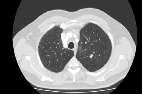 CT scan with tumor in the left lung