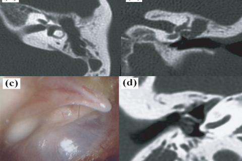 Figure 2: CT scan of the left temporal bone reveals an area of soft density in the epitympanum and lateral semicircular canal fistula in the axial (a) and coronal (b) views. A white mass was observed through the posterior superior quadrant of the right tympanic membrane (c). A round area of soft density was displayed behind the tympanic membrane on the right axial view of CT scan (d).
