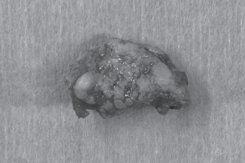 Figure 4: The gross appearance of the resected tumor indicated that it was composed of cartilaginous and osseous components.