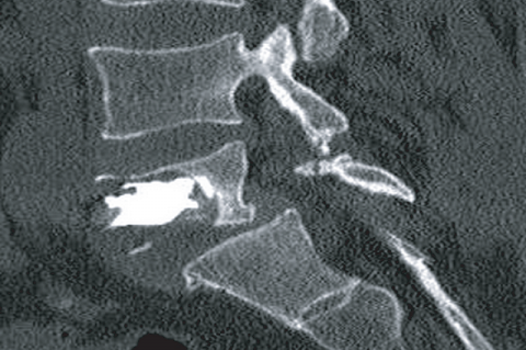Figure 3: Post-KP CT demonstrates PMMA filling the majority of the lytic cavity.