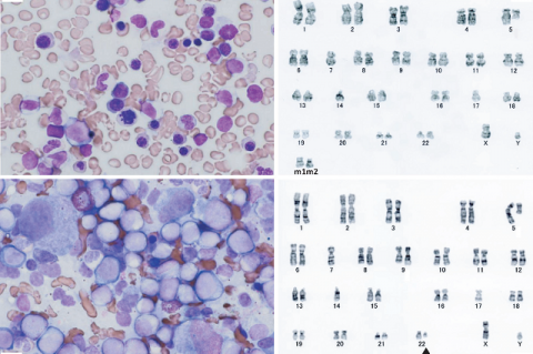 Figure 1: Bone marrow morphology and G-banding revealed clonal evolution. (a) Bone marrow smear (Wright- Giemsa, 1,000×) showed MDS at diagnosis. (b) Karyotype at MDS diagnosis was 46,XY,del(5)(q?)[1]/45,XY,idem, -7,-14,-17,+mar1,+mar2[7]/45,XY,-5[4]/46,XY[8]. A major abnormal clone is shown in Figure 1(b). (c) Bone marrow smear (Wright-Giemsa, 1,000×) showed AML with multilineage dysplasia upon progression of anemia 4 months after MDS diagnosis. The size of the blast cells ranged from medium to large; they