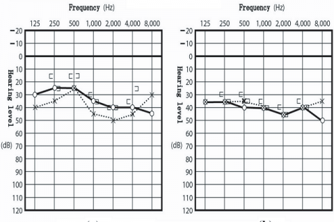 Figure 1: Audiogram of pure-tone audiometry. A difference of > 10 dB between the right (◦) and left ear (×) was detected at an 8-kHz frequency at (a) the initial visit (March 26, 2009) (b) but not at a follow-up visit, when the acoustic tumor was no longer visible on MRI (May 12, 2012).