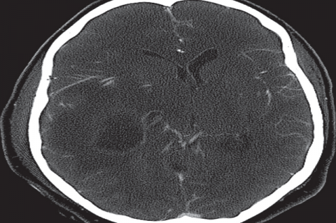 Figure 2: Right temporal lobe abscess with mass and edema displaying tissue displacement and midline deviation.