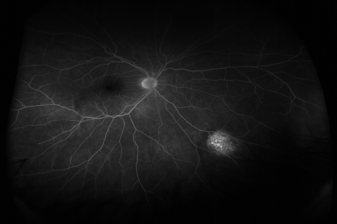 Figure 1: Fluorescein angiogram, right eye, early venous phase demonstrates stippled hyperfluorescence in the area of identified choroidal lesion.