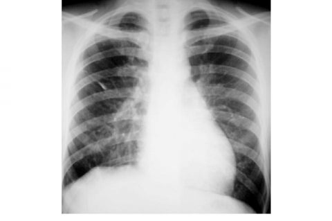 Figure 3. Post-operative chest radiograph 6 months after surgery