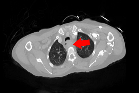 Figure 1. Chest CT: diffuse circumferential wall thickening and luminal narrowing of the mid esophagus