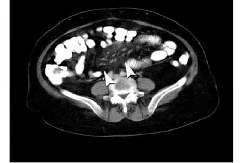 Figure 1. Axial contrast–enhanced CT image showed a hyperattenuated fatty mass with pseudocapsule (arrow) at the mesenteric root