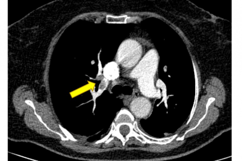 Figure 2. Multidetector computed tomographic pulmonary angiography shows a thrombus located in the right pulmonary artery.