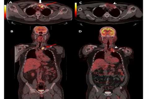Figure 1. F18-FDG PET-CT before and four months after surgical treatment: Bone metastasis on the left side of the sternal manubrium (white arrow) and recurrence in the thyroid bed (red arrow) are identified as FDG-avid lesions and on the axial (A) and coronal (B) fusion images. Four months after surgical treatment, F18-FDG PET-CT axial (C) and coronal (D) views show a mild uptake (arrowhead)