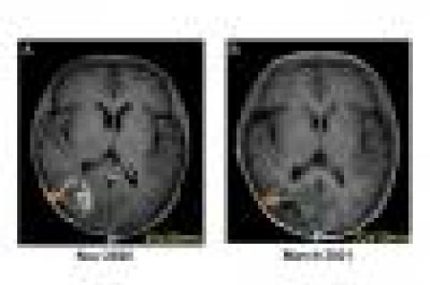 (A) Brain MRI showed right parietal-occipital hemorrhage suspicious from metastasis (Nov 2020). (B) The lesion remarkably subsided with very faint enhancement (March 2021).