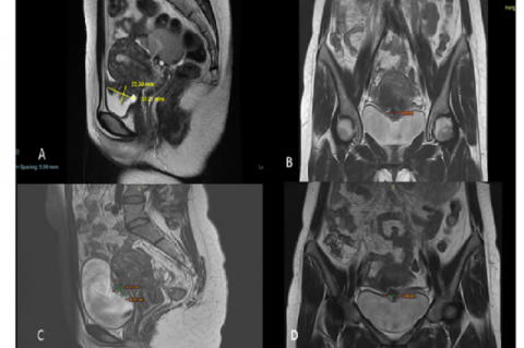 Sagittal and coronal MRI scans showed T2 hypointense, and T1 isointense bladder lesions