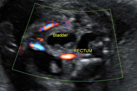 23 GW; urinary bladder after rupture of the bladder wall (yellow arrow) rectal dilation (red arrow) in a male fetus with posterior urethral valves