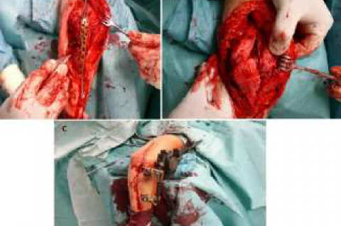 A: Intraoperative view of the site