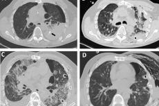 (A) CT scan showing chest drainage (black arrow) causing lung laceration with adjacent large hemothorax (Day 1), (B) Postoperative CT scan showing intraparenchymal bleeding into the left lung, (C) CT scan showing severe ARDS (Day 3), (D) CT scan after weaning from PMLV (Day 13).